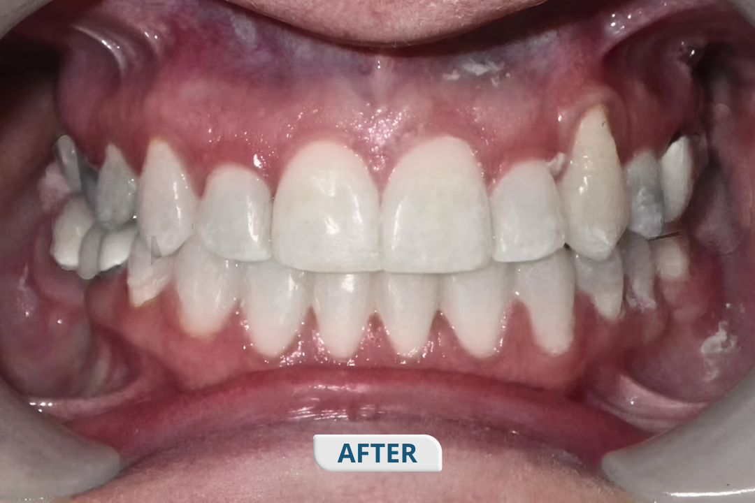 After treatment at Namira Oro Dental Care